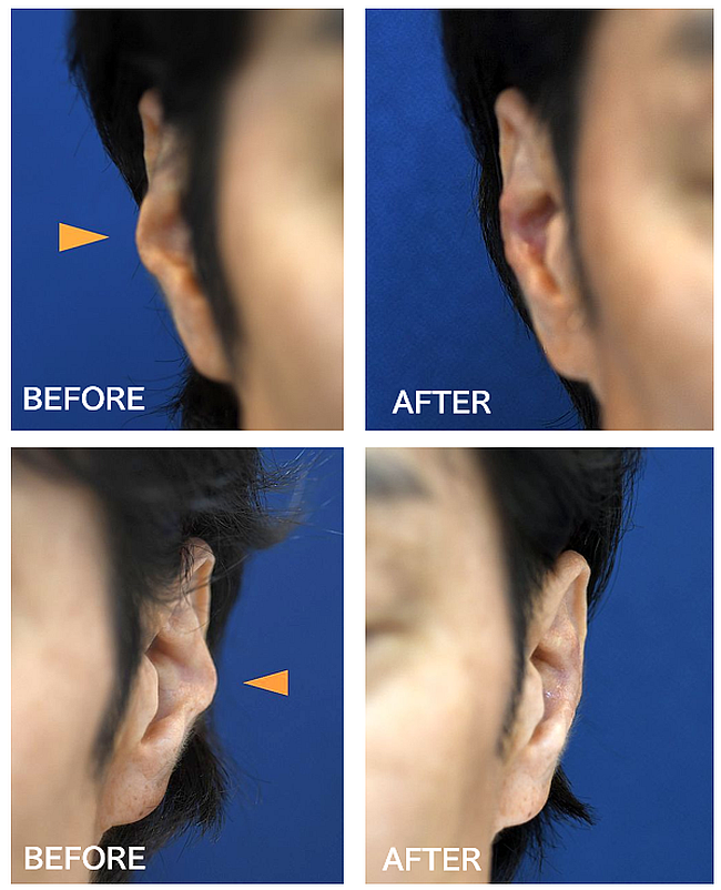 耳の軟骨整形の症例