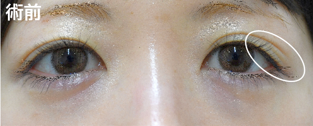 三重まぶた治療の症例写真