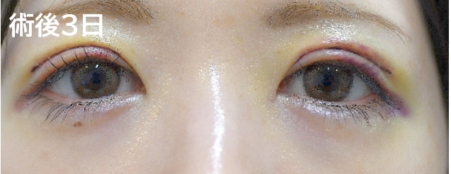 三重まぶた治療の症例写真