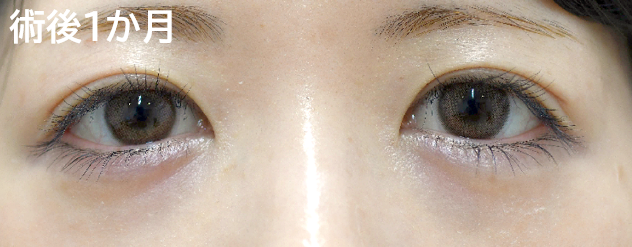 三重まぶた治療の症例写真