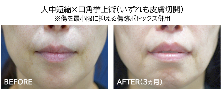 人中短縮＋口角挙上の症例写真