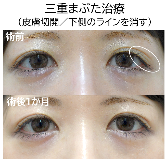 三重まぶた治療の症例写真