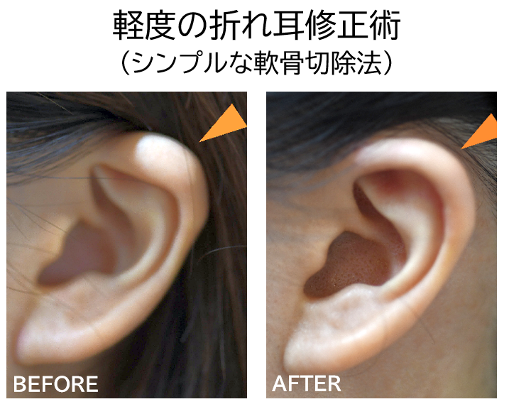 折れ耳修正の症例写真