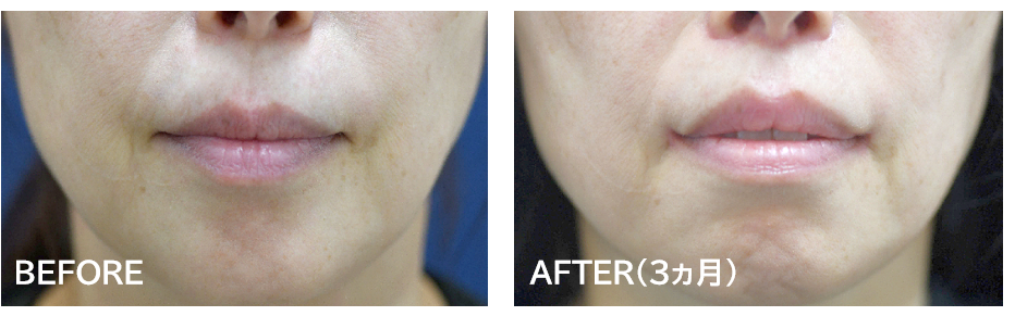 人中短縮＋口角挙上の症例写真