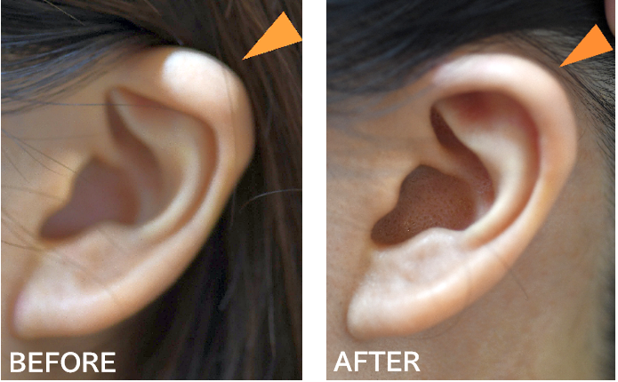 折れ耳修正の症例写真