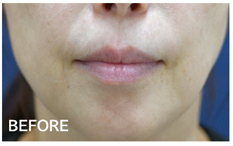 人中短縮＋口角挙上のビフォーアフター