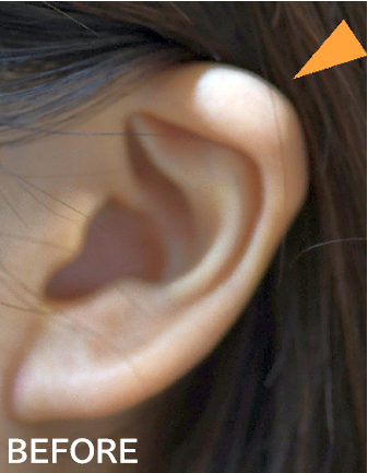 折れ耳修正の症例写真
