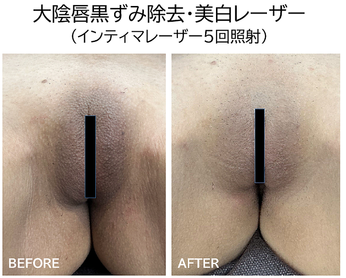大陰唇の黒ずみ取りレーザーの症例写真