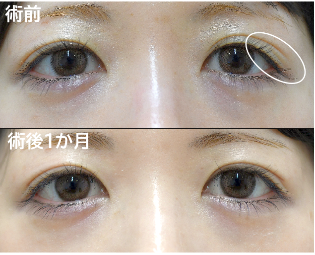 三重まぶた治療の症例写真