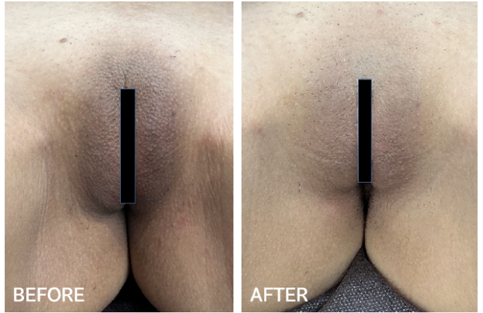 大陰唇の黒ずみ取り症例写真