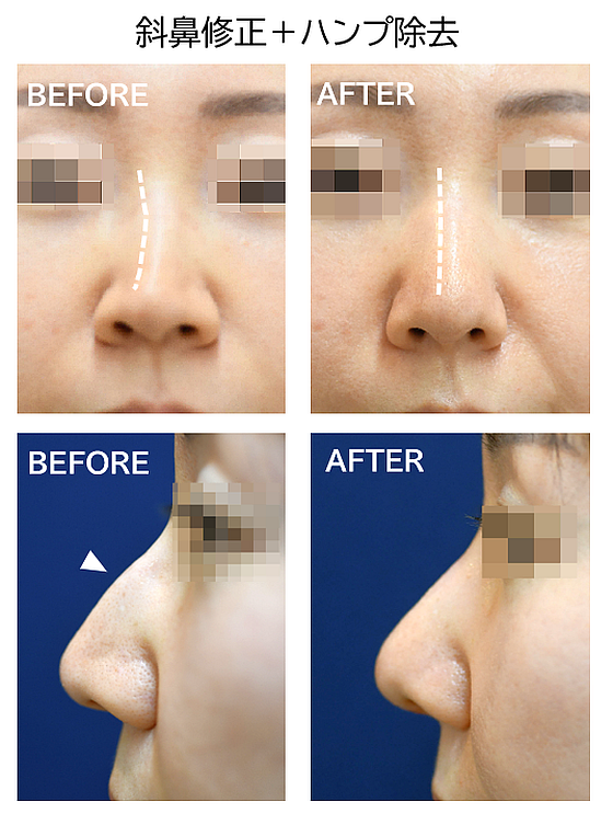斜鼻修正とハンプ除去のコンビ症例