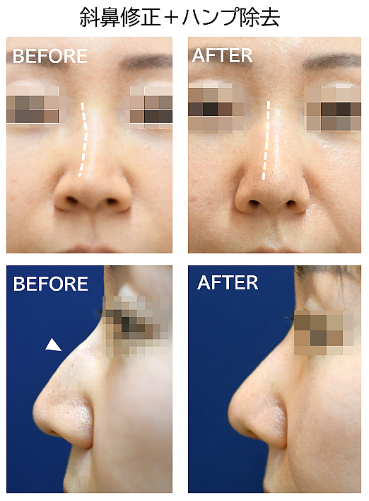 斜鼻修正＋ハンプ削りの症例写真