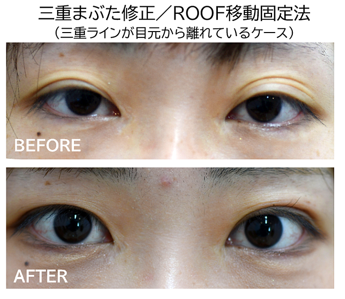 三重まぶた修正術の症例写真