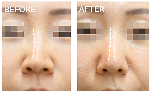 斜鼻修正＋ハンプ削りの症例写真