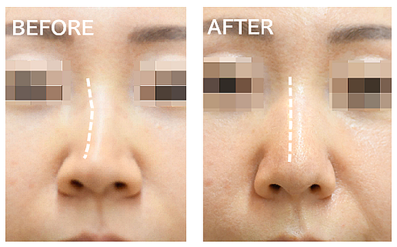 斜鼻修正・ハンプ除去の症例写真