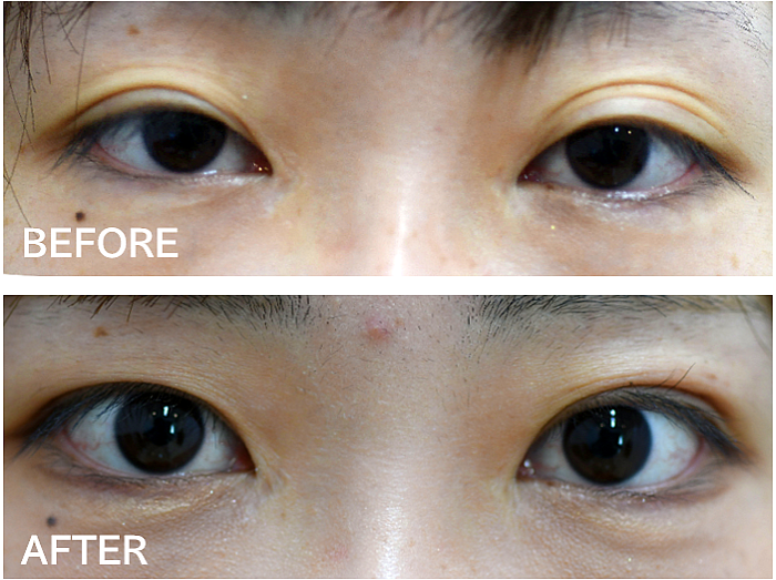 三重まぶた修正術の症例写真