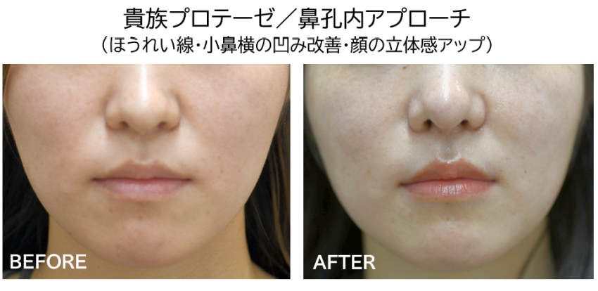 貴族プローテゼの症例写真