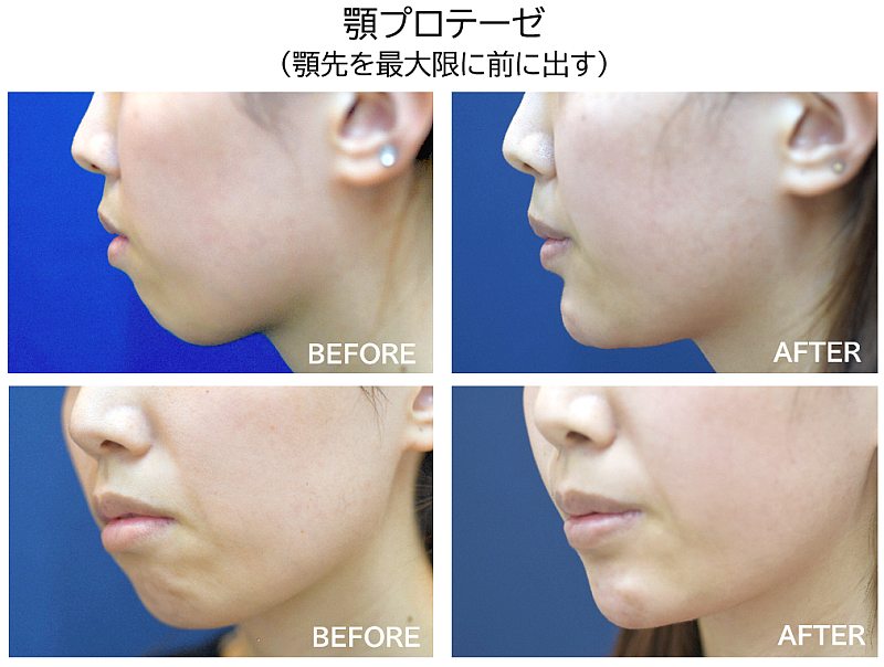 顎プロテーゼの症例写真