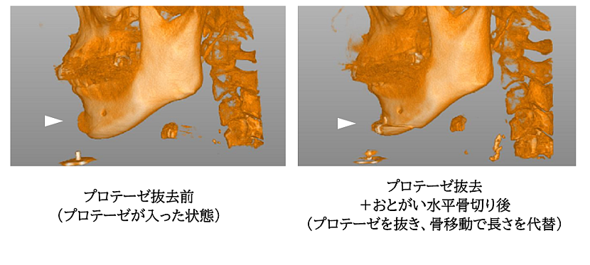 顎プローテゼ抜去＋おとがい形成の症例写真