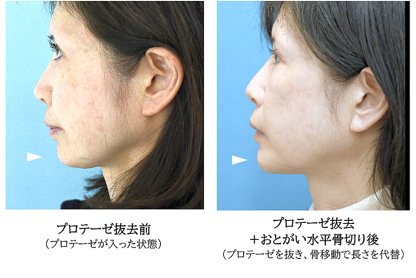 顎プローテゼ抜去＋おとがい形成の症例写真