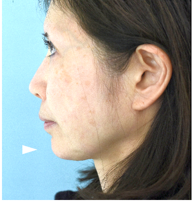 顎プローテゼ抜去＋おとがい形成の症例写真