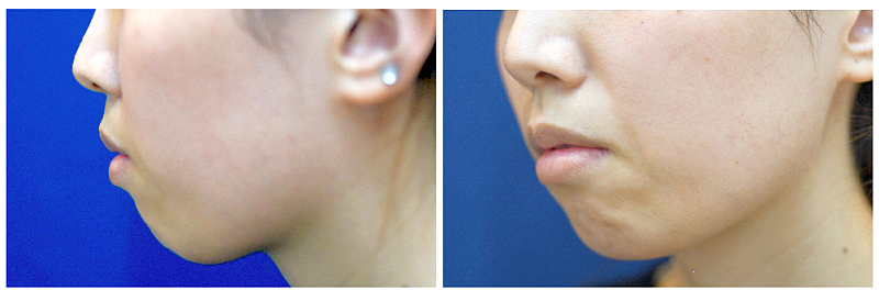 顎先プロテーゼ