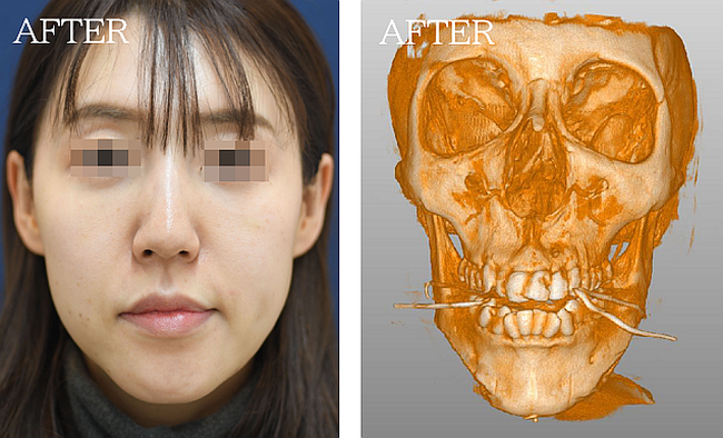 Vライン形成の症例写真