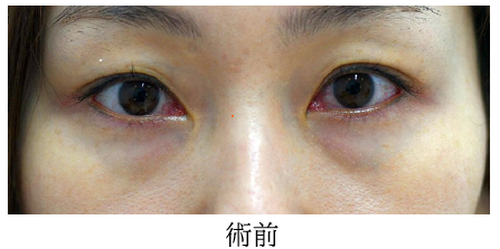 目の下のクマ治療（脂肪注入）の症例写真