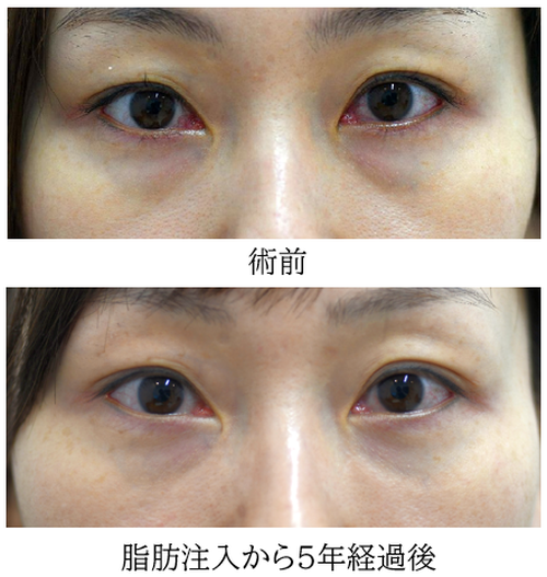 目の下のクマ治療（脂肪注入）の症例写真