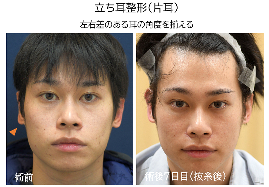 立ち耳にする整形の症例写真