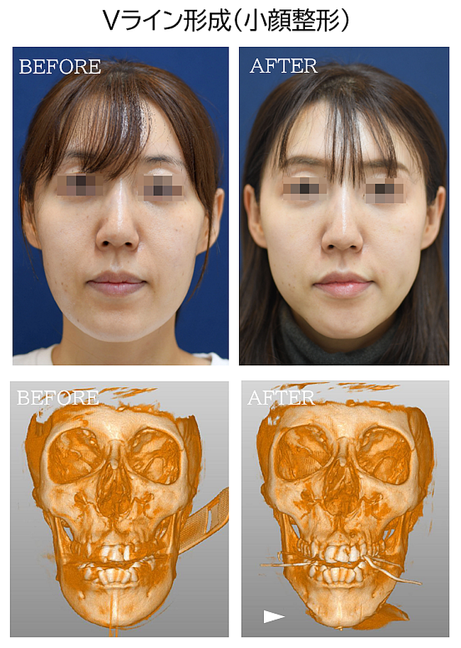 Vライン形成の症例写真