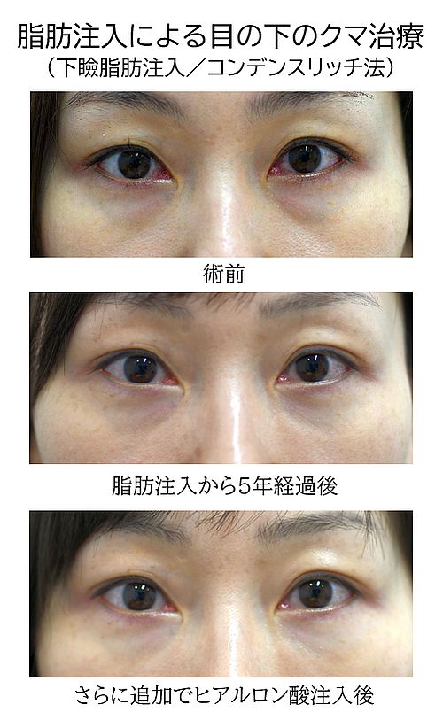目の下のクマ治療（脂肪注入）の症例写真