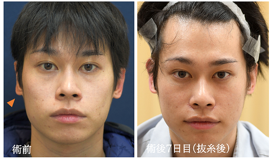 立ち耳にする整形の症例写真