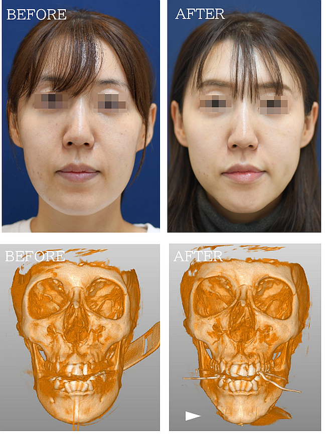 Vライン形成の症例写真