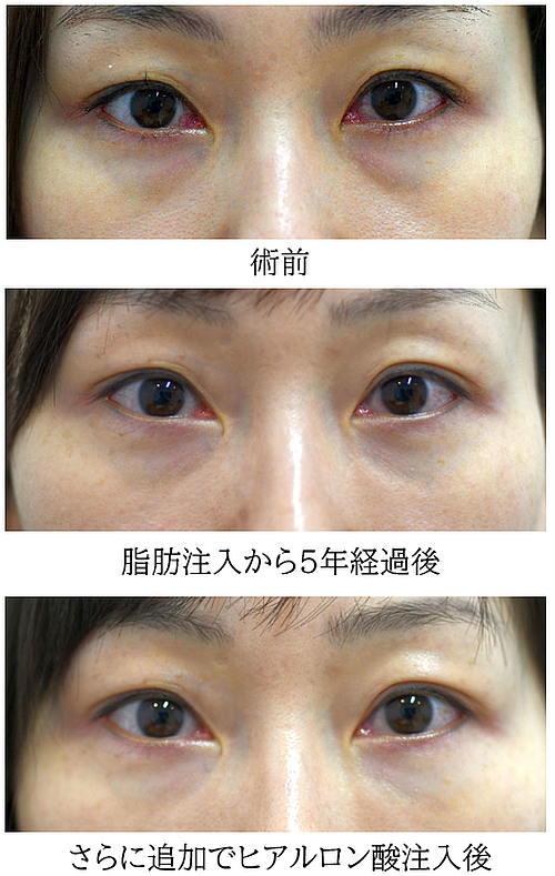 目の下のクマ治療（脂肪注入）の症例写真