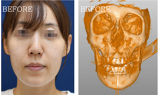 Vライン形成の症例写真