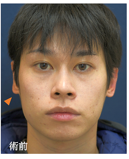 立ち耳整形の症例写真