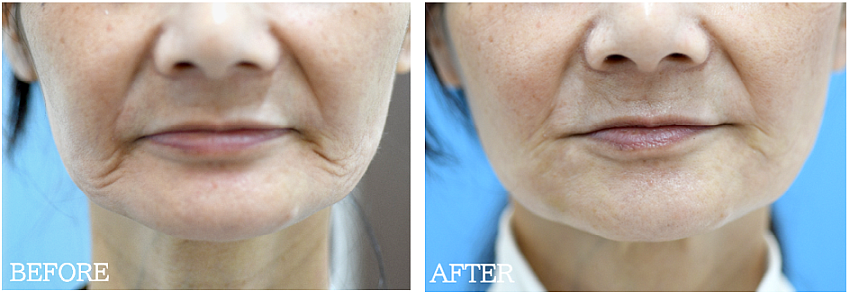 マリオネットライン治療の症例写真