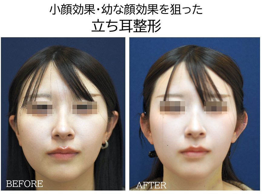 立ち耳整形（小顔）の症例写真