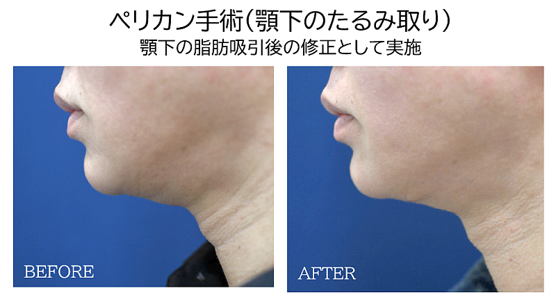 ペリカン手術の症例写真