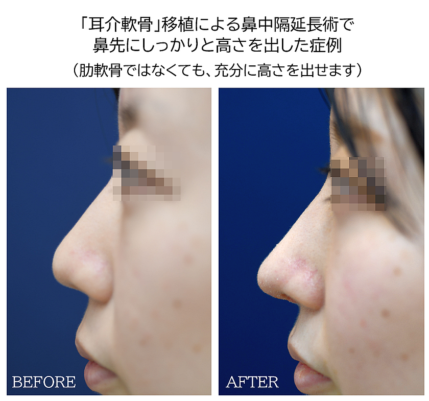 鼻中隔延長術の鼻整形症例写真