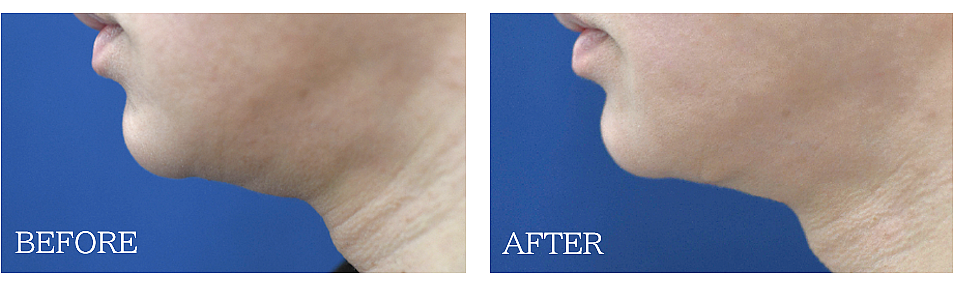 ペリカン手術の症例写真