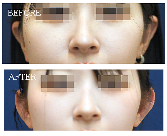 立ち耳整形（小顔）の症例写真