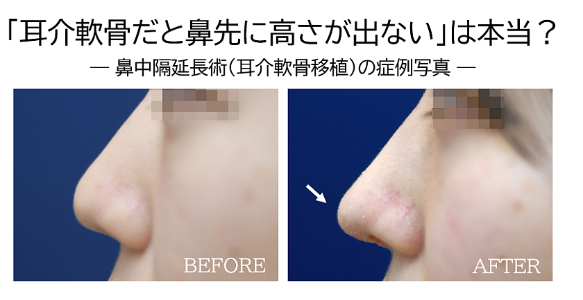 鼻中隔延長術の症例