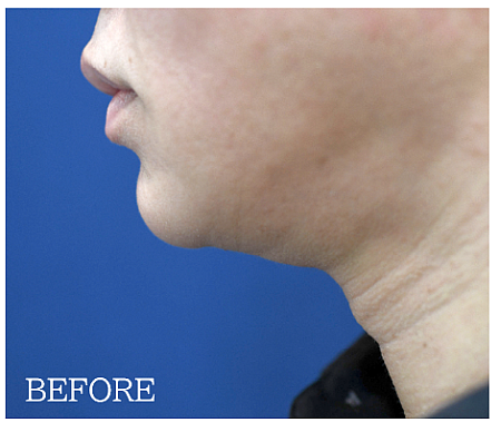 ペリカン手術の症例写真