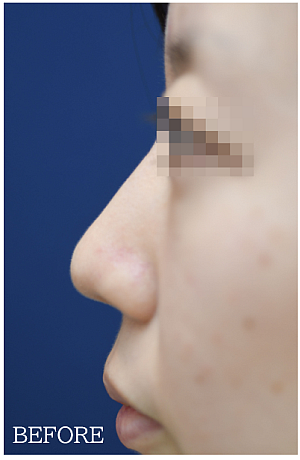 鼻中隔延長術の鼻整形症例写真