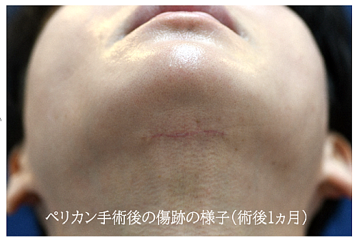 ペリカン手術の症例写真