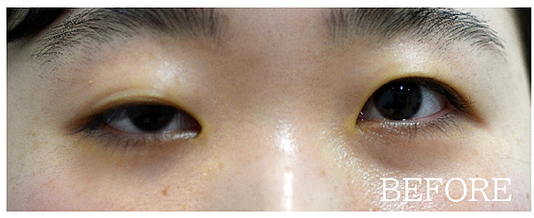 重度の眼瞼下垂手術の症例写真（挙筋腱膜法）