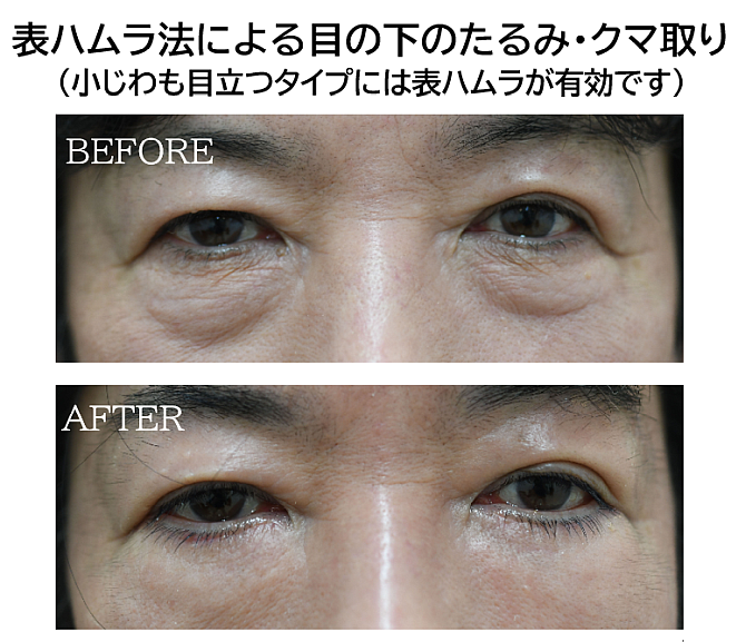 目の下のたるみ取り症例写真