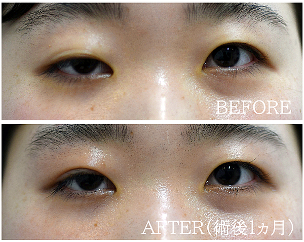 重度の眼瞼下垂手術の症例写真（挙筋腱膜法）
